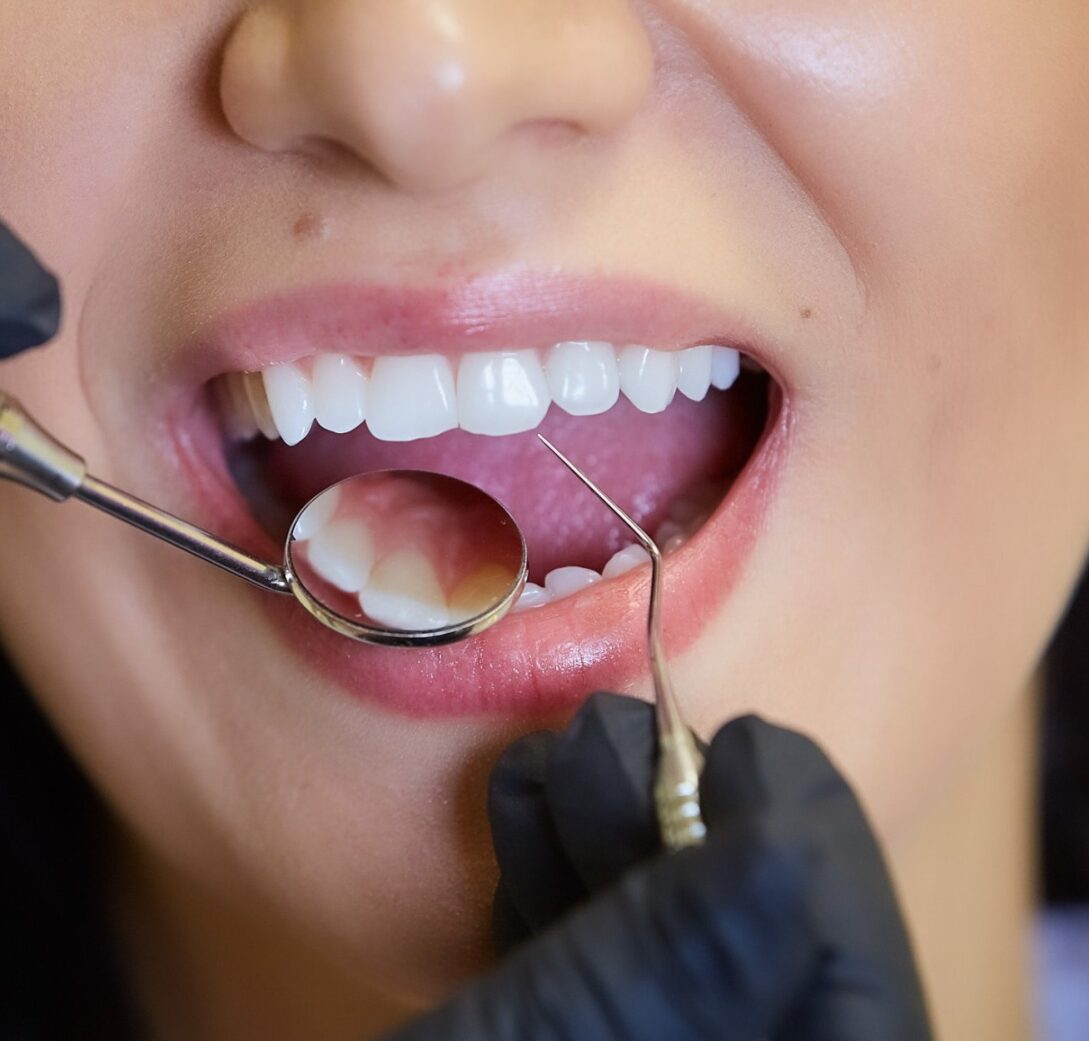 How Often Should You Schedule a Dental Checkups?