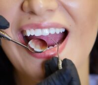 How Often Should You Schedule a Dental Checkups?