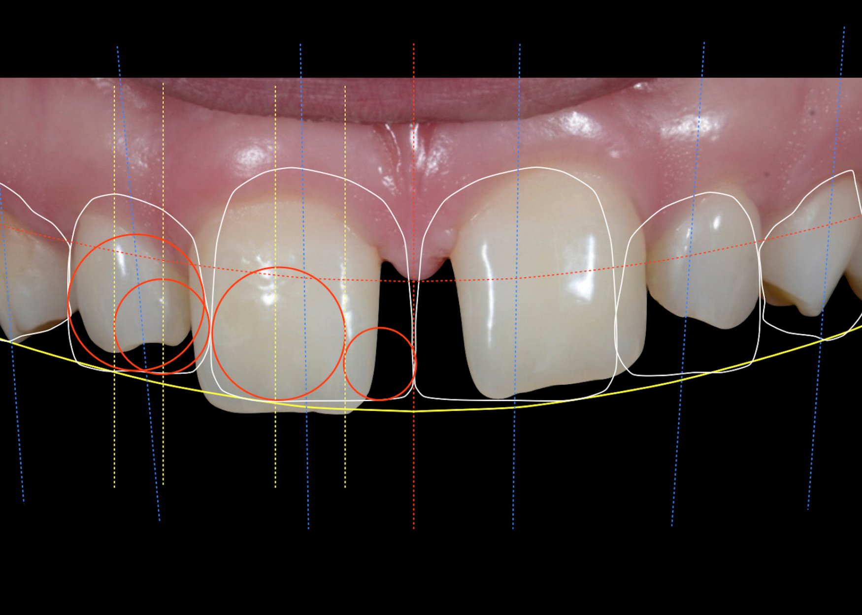 Transform your smile with expert smile design and correction services at our dental clinic. Achieve your dream smile today.