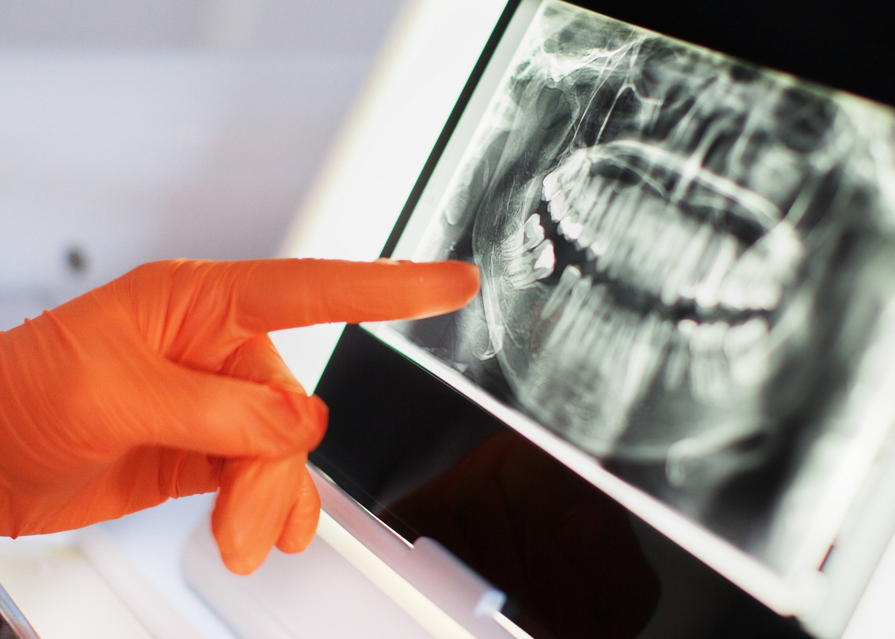 Get accurate dental X-rays at Sparsh Dental Clinic in Bilaspur for effective diagnosis and personalized treatment plans.