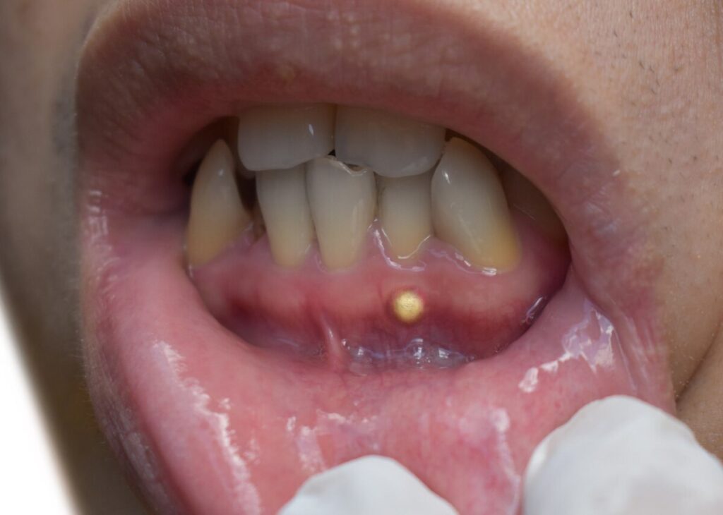 Inflamed and swollen gum tissue with a pus-filled near a tooth.