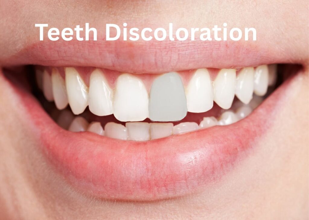 A close-up of a person's teeth showing yellow and darkened areas indicating teeth discoloration.