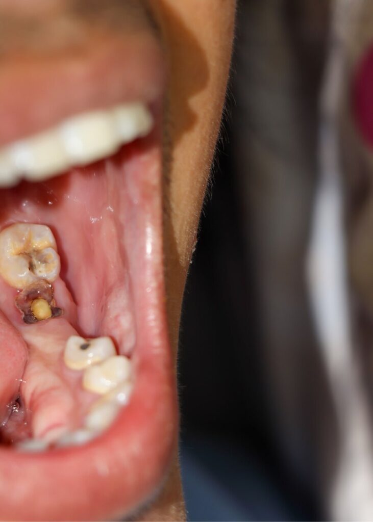 Understanding Cavity Symptoms