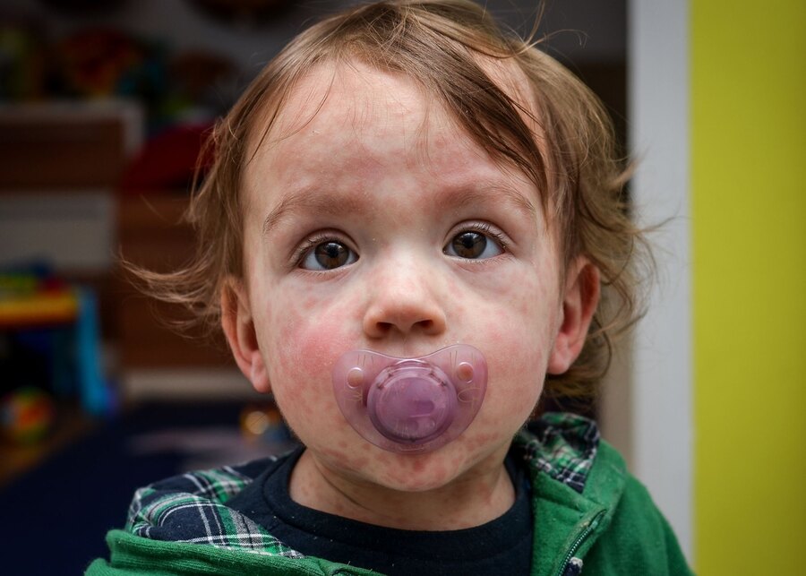 A child looking tired, face and body red and splotched with a rash indicative of measles symptoms.
