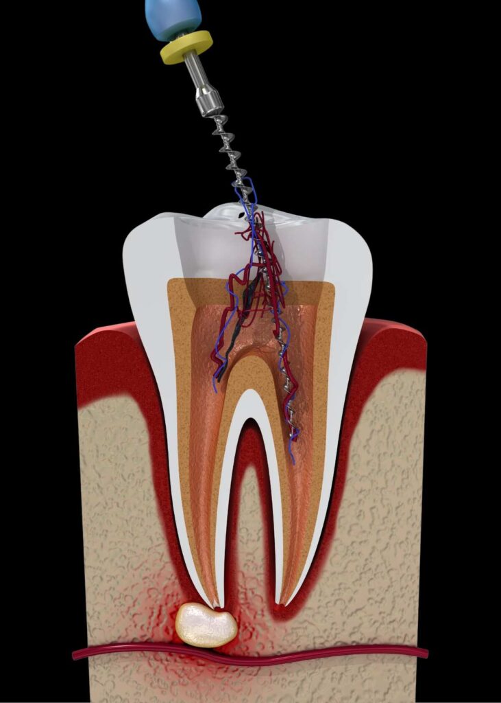 A root canal procedure on a tooth using specialized dental tools.