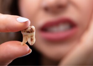 warning tooth cavity symptoms