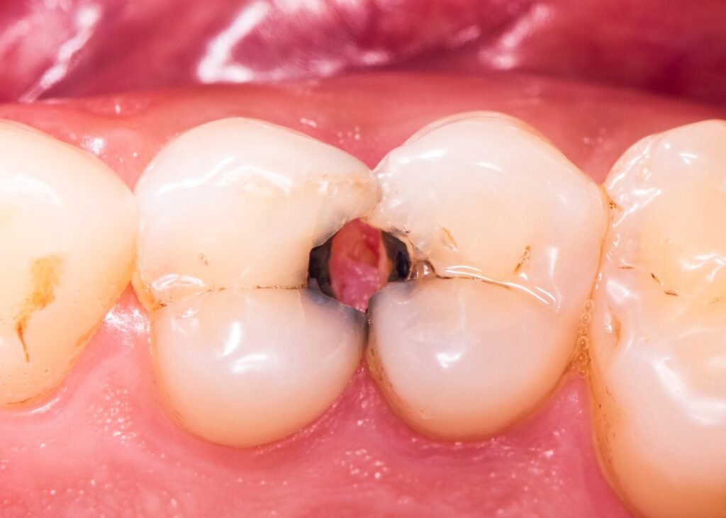 Visit Sparsh Dental Clinic in Bilaspur, the best dental clinic for tooth decay treatment, ensuring effective care for your smiles.