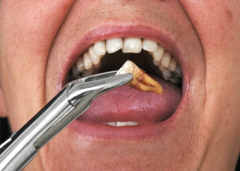 Tooth Removal