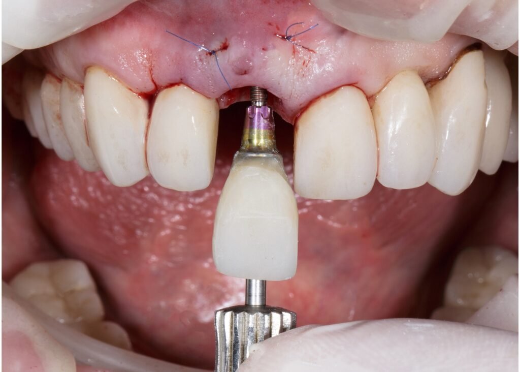 Transform your smile with dental implants at Sparsh Dental Clinic in Bilaspur. Quality care for lasting results.